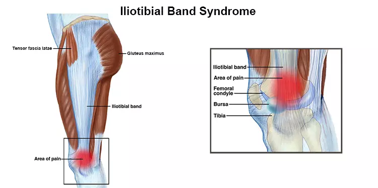 IT Band Syndrome (ChoosePT.com) b