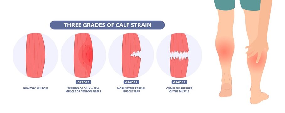 Calf Strain (Adobe Stock)