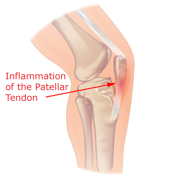 Patella Tendonitis (Wikimedia Commons) - Labelled