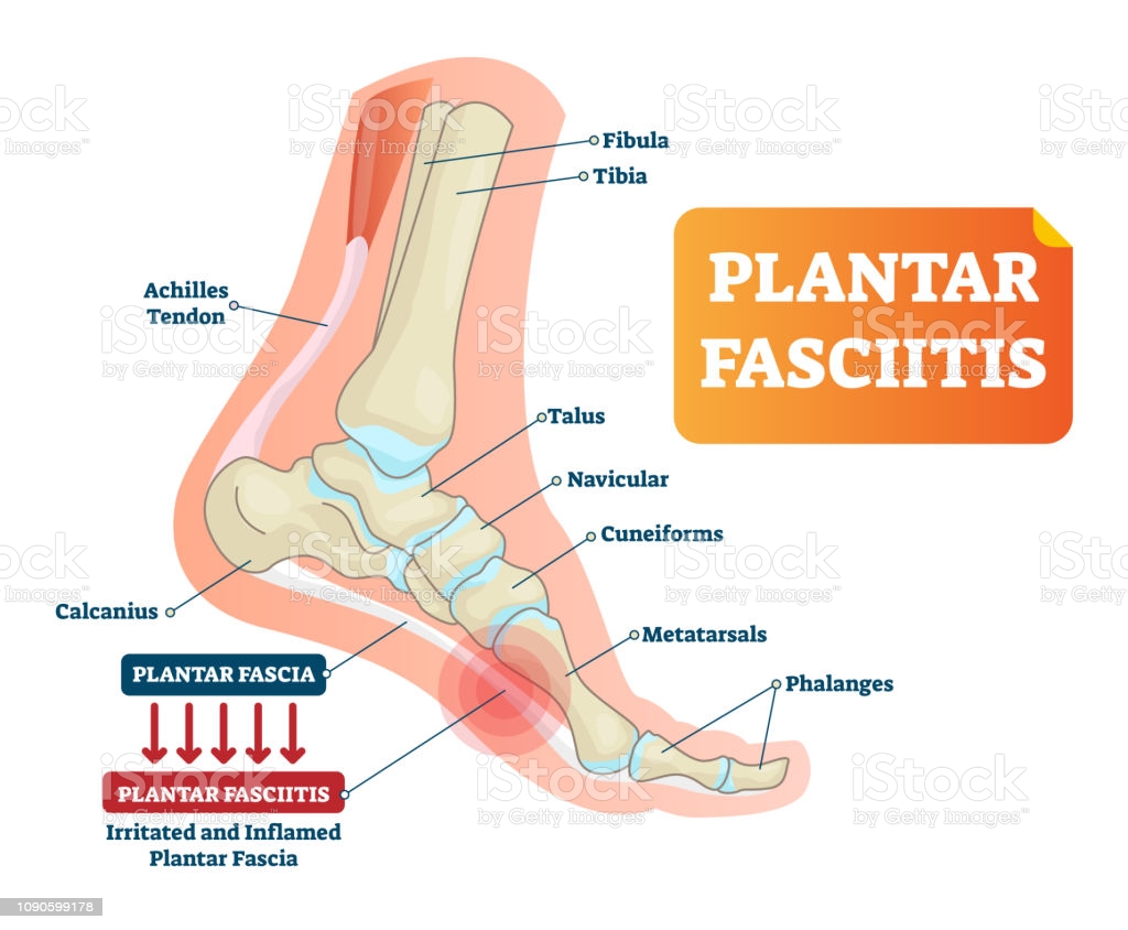 Plantar Fasciitis Side (VectorMine, Getty Images)